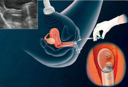 方法才是关键 方法才是关键怎么做 取卵是不是越多越好？这才是提高成功率的关键！