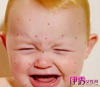 小孩长水痘要注意什么 小孩长水痘图片 小孩长水痘要注意什么