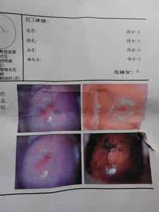 宫颈炎的症状用什么药 宫颈炎的症状用什么药 宫颈炎会有什么症状