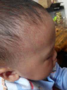 小孩出痱子怎么办 宝宝长痱子怎么办 宝宝长痱子该怎么做