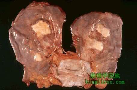 石棉小体是石棉肺的 石棉肺是怎么回事