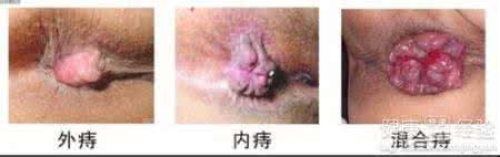 外痔疮的最佳治疗方法 外痔疮的治疗方法 外痔疮的最佳治疗方法