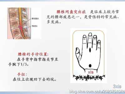 幼儿园春季保健知识 手诊保健知识（30）腰椎间盘突出症