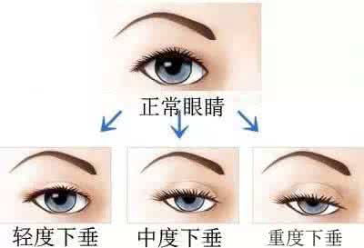 双眼皮贴的危害 双眼皮贴的危害 双眼皮贴哪种好