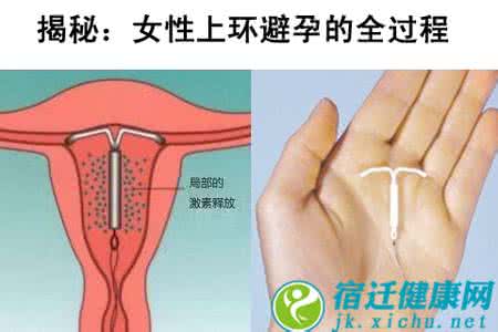 上环最佳时期 女性避孕“上环”的最佳时期