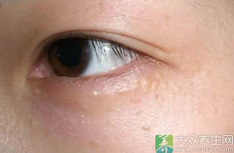 去除眼部脂肪粒小偏方 眼部脂肪粒怎么祛除