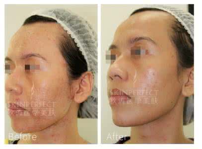 治疗痘痘用什么方法好 治疗痘痘用什么方法好 哪些方法治疗痘痘好