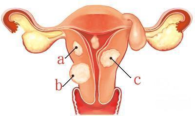 先天性无子宫怎样冶疗 先天性无子宫怎样冶疗 先天性无子宫并非不治之症