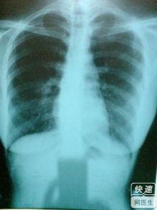 胸膜炎的症状有哪些 胸膜炎的症状 有这个症状就是患了胸膜炎