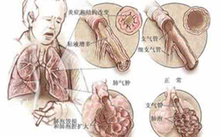 慢阻肺的症状 慢阻肺的症状 慢阻肺有这三种常见的症状
