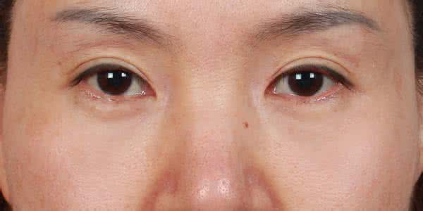 怎么祛除眼角皱纹 消除眼角皱纹的方法 快速祛除眼角皱纹的方法