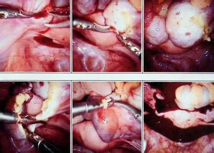 巧囊腹腔镜手术后打针 腹腔镜巧囊手术后打诺雷得针月经没来正常吗