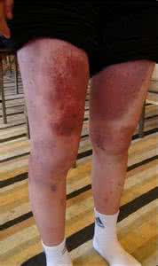 红斑狼疮性肾炎 18岁红斑狼疮性肾炎女孩停药纪实（附照片）