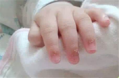 孩子手上长倒刺怎么办 宝宝手指上长倒刺怎么办