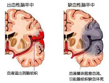 肝血不足中医宝典 【健康宝典】喝水不足易脑卒中!最伤大脑的8件事