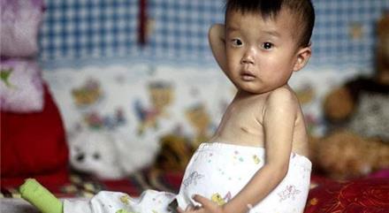 男童肚子疼 4岁男童患罕见病肚大如篮球 了解什么是戈谢氏病
