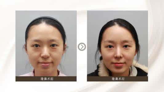 女生塌鼻子隆鼻对比照 塌鼻子隆鼻 塌鼻子隆鼻前后对比
