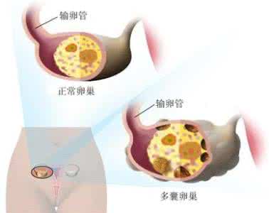 多囊卵巢综合症的食谱 多囊卵巢综合征怎么办