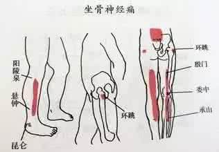 三叉神经痛病例 三叉神经痛的艾灸方法,附病例、穴位图