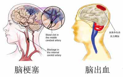 脑溢血与脑梗塞的区别 脑梗塞、脑溢血的解说