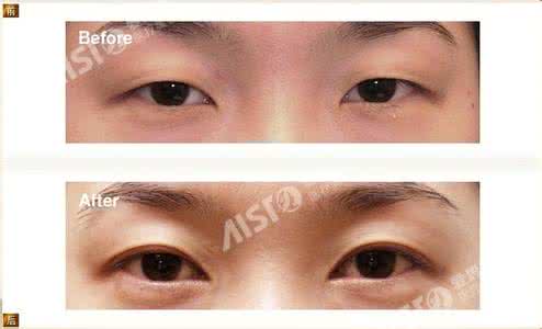 开眼角多长时间恢复 开眼角手术多长时间 做开眼角手术多长时间可以恢复?