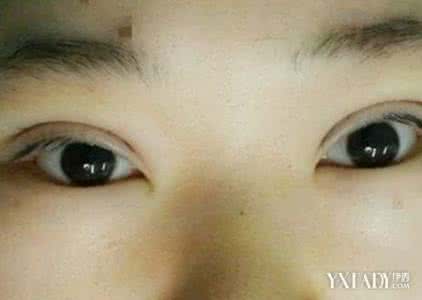 肿眼泡适合做双眼皮吗 肿眼泡适合做双眼皮吗 什么样的的人适合做双眼皮
