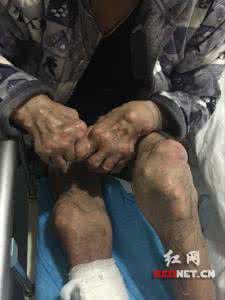 中医治疗痛风病 我是如何发现桔梗治疗痛风病的