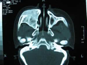气压损伤性中耳炎 鼻窦气压伤是怎么回事