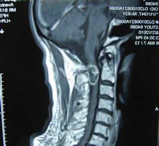 髓内外肿瘤鉴别 髓内外肿瘤的鉴别 太极之髓——内外相合