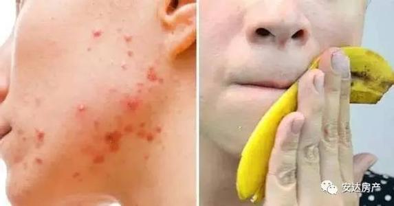 痘痘发炎红肿怎么消炎 痤疮消炎 怎么消炎痘痘红肿 方法是什么