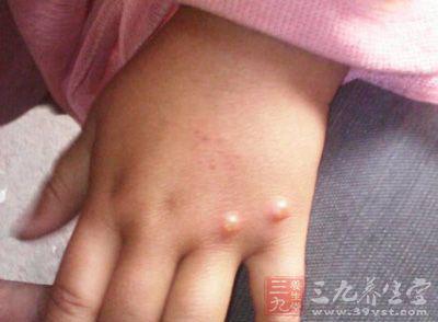 小孩出水痘注意事项 小孩起水痘怎么办 五种禁忌一定要注意