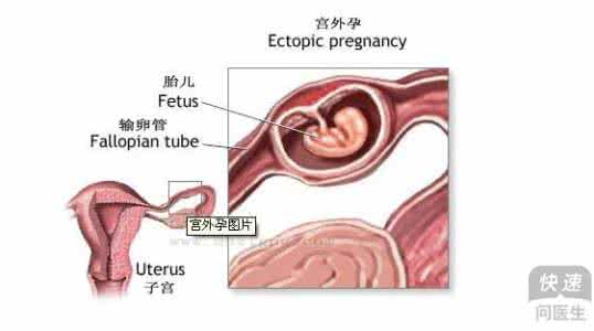 宫外孕做手术疼吗 宫外孕手术疼吗 宫外孕做手术疼吗？