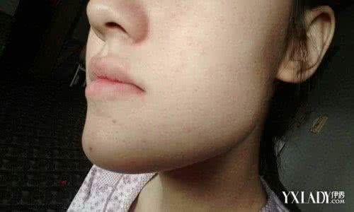 怎么去除脸上的死皮 怎么去除脸上的死皮?