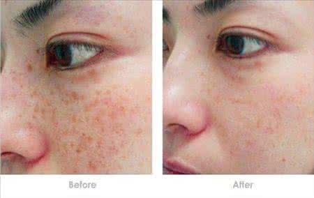 激光祛斑的费用 激光祛斑费用 激光祛斑的费用