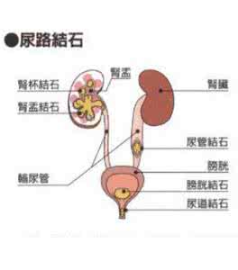 尿路结石图片 一图读懂 · 尿路结石