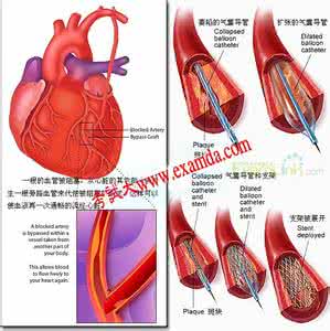慢性心力衰竭的治疗 慢性心力衰竭 慢性心力衰竭的治疗与预防