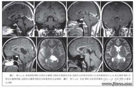 前列腺囊肿的临床表现 前列腺囊肿的临床表现 松果体囊肿 它的临床表现是什么