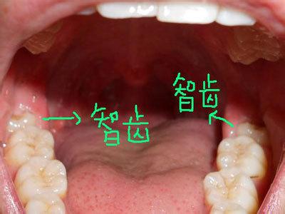 吃东西老是塞牙怎么办 吃东西时老塞牙该怎么办