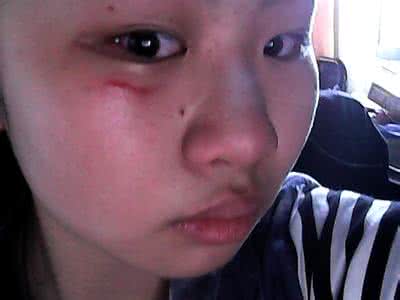 脸部擦伤用什么药 脸部擦伤外用什么药好？