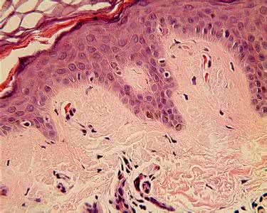 对称性色素异常症图片 皮肤色素异常