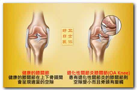 针灸治疗膝关节炎 针灸治疗膝关节炎 四个针灸方法治疗膝关节炎