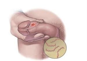 怎样治疗肛周尖锐湿疹 治疗尖锐湿疹是怎样 患者的饮食有哪些