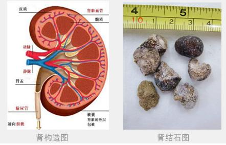 肾结石的治疗方案 肾结石治疗方案 肾结石治疗的四种治疗方案