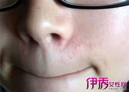 鼻子疼导致牙疼 鼻子里面疼 导致鼻子里面疼的原因