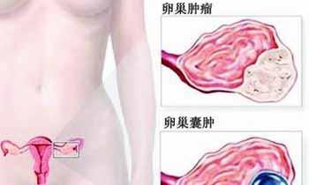 卵巢囊肿有什么症状 卵巢囊肿有什么症状 女人得卵巢囊肿症状有什么