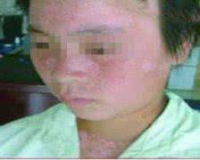 儿童皮肤白点病 儿童皮肤白点病 儿童皮肤黑怎么变白呢