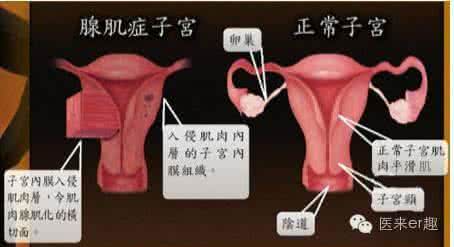 治疗子宫腺肌症痛经 治疗子宫腺肌症痛经 子宫腺肌症痛经能治吗？