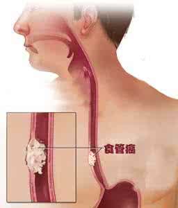 死刑犯食道癌民间偏方 民间偏方三则（治疗食道癌、胃溃疡、麦粒肿）