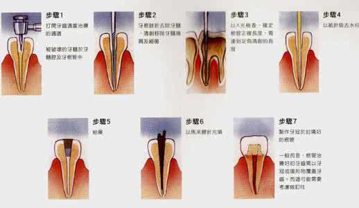 牙齿根管治疗需要几次 哪些牙齿疾病需要做根管治疗？