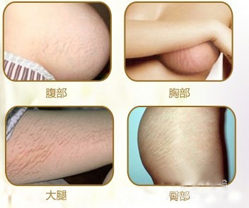 去除妊娠纹的小妙招 3个小妙招成功去除妊娠纹